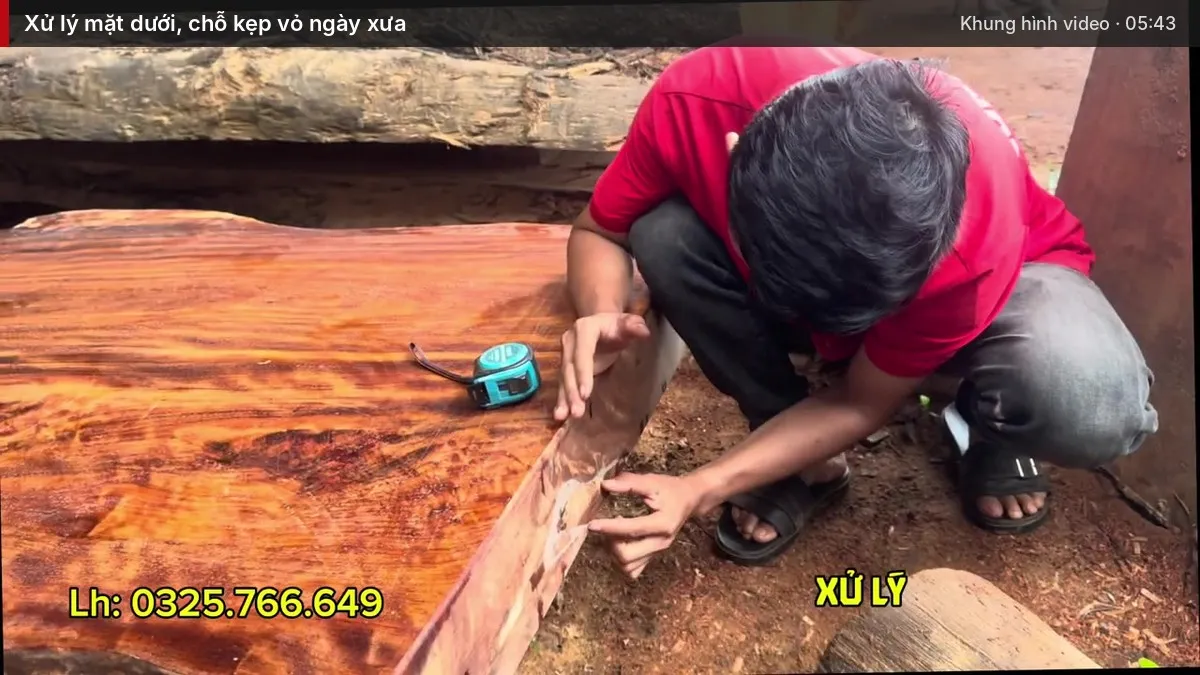 Em Chiến chỉ phần mặt dưới, chỗ kẹp vỏ ngày xưa đang được xử lý